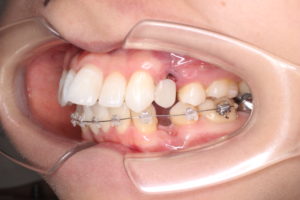 抜歯と仮歯