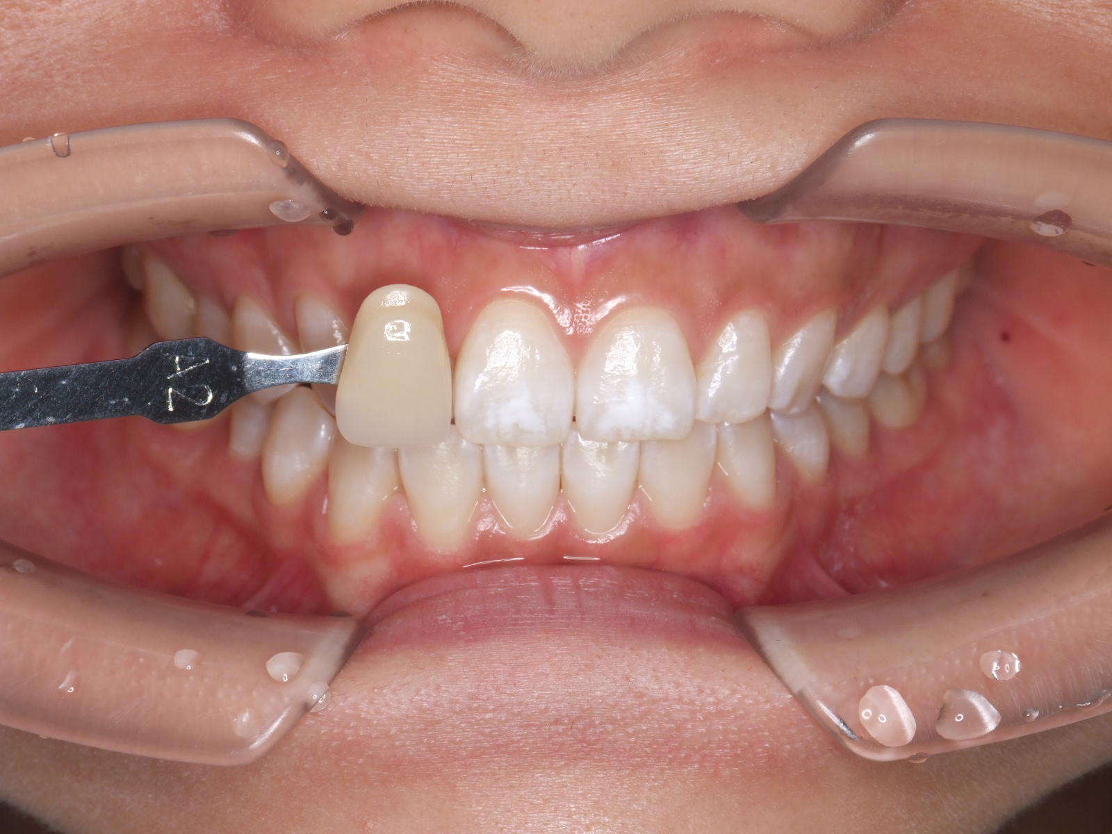 歯 の ホワイトニング 恵比寿