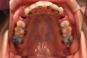🦷抜歯と装置🦷