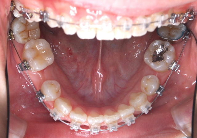 第７回　調整　＋　歯の形態修正